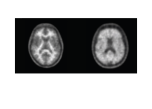 Neuraceq<sup>®</sup> <br> Beta Amyloid Imaging